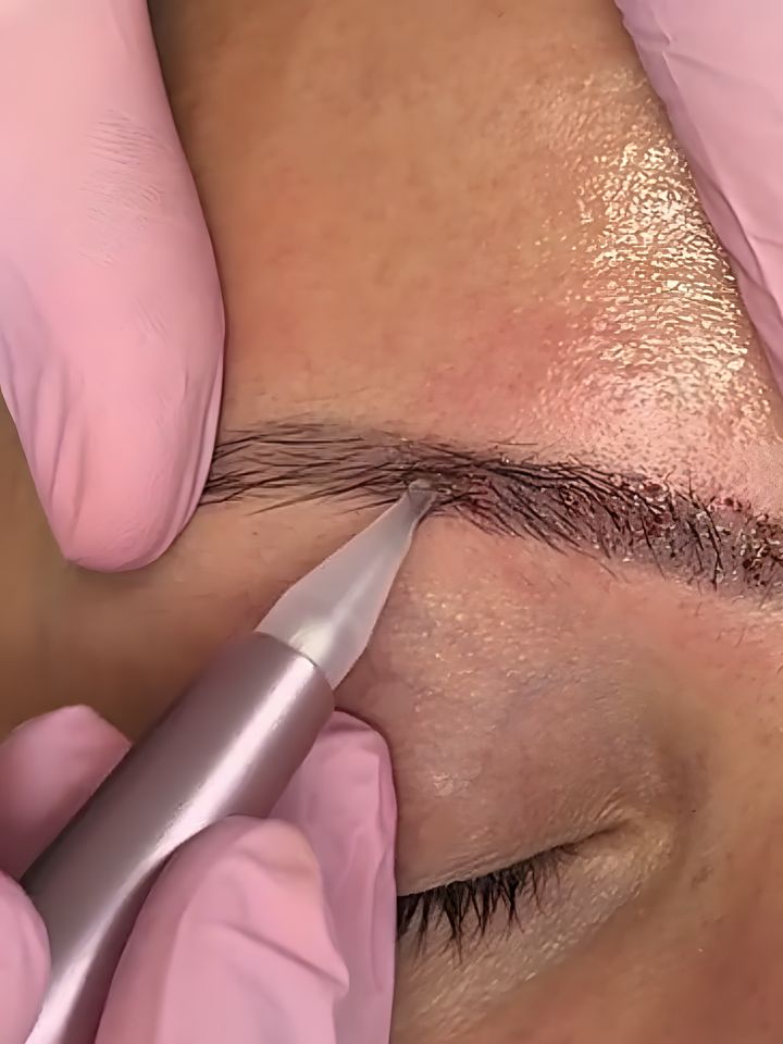 Dermógrafo aplicando o despigmentante na sobrancelha