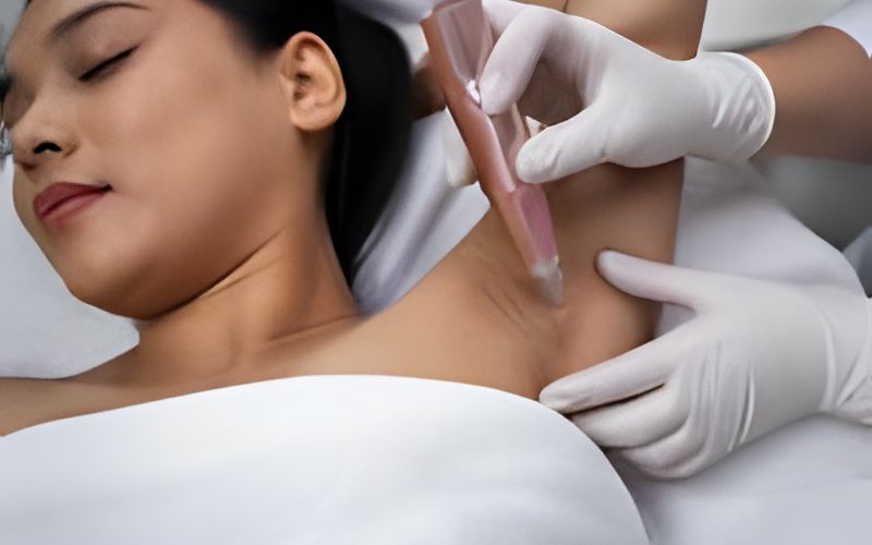 Ilustração gerada por IA: clareamento de axila com dermógrafo