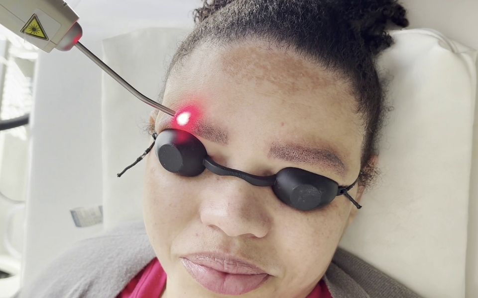 Laser de baixa potência aplicado após a remoção, em uma aula prática
