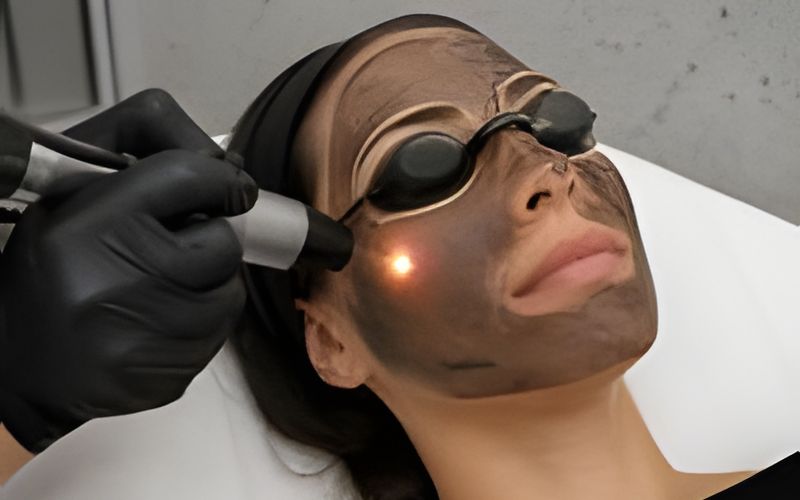 Ilustração gerada por IA: peeling de Hollywood com máscara de carbono e disparo do laser