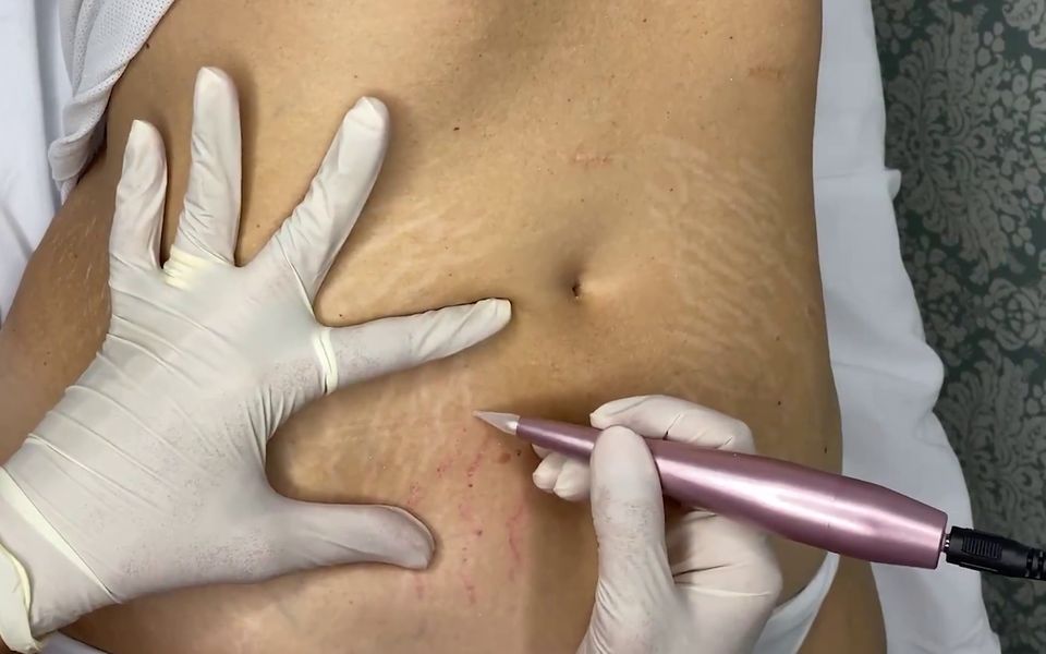 Tratamento de estrias com dermógrafo em uma aula prática